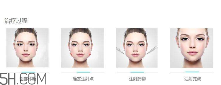 打瘦臉針可以抽煙嗎？打瘦臉針會(huì)反彈嗎？