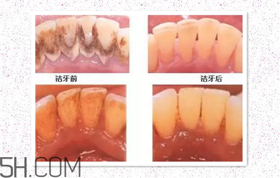 超聲波洗牙可以美白牙齒嗎？超聲波洗牙多少錢一次？