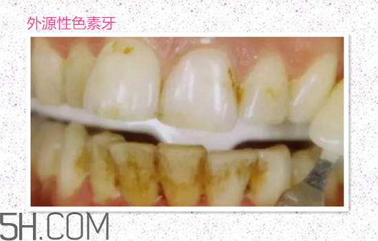 超聲波洗牙可以美白牙齒嗎？超聲波洗牙多少錢一次？