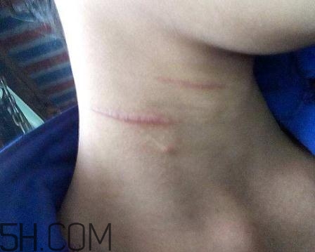 密麗除疤膏怎么用？密麗除疤膏什么時(shí)候用？