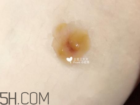 美寶濕潤(rùn)燒傷膏怎么樣？美寶濕潤(rùn)燒傷膏有用嗎？