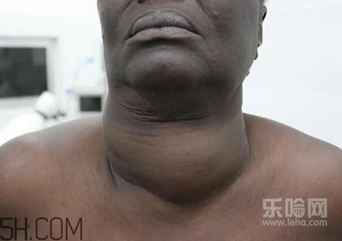 甲狀腺腫大和甲亢的區(qū)別有哪些？甲狀腺腫大適合吃什么食物？