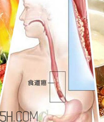 吃太燙會(huì)得癌？燙食不僅對(duì)胃不好還容易得癌
