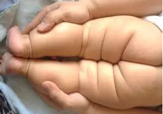 寶寶腿紋不對稱是怎么回事？嬰幼兒的生長發(fā)育標準是怎樣的？