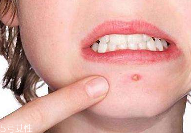 下巴起痘怎么辦？超好用祛痘辦法分享