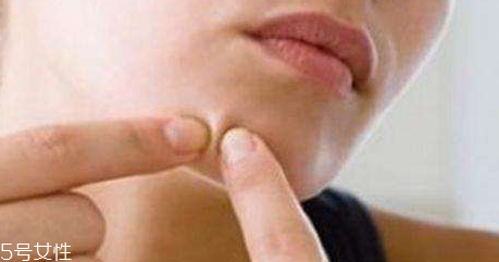 下巴起痘怎么辦？超好用祛痘辦法分享