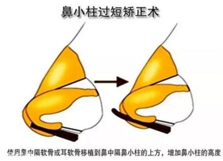 鼻小柱延長用什么材料？優(yōu)先選擇鼻中隔軟骨
