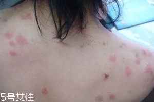 螨蟲有哪些危害？嚴重時肌膚糜爛