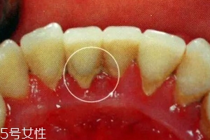 牙結石能自動脫落嗎？除了洗牙別無他法