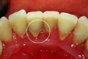 牙結(jié)石能自動脫落嗎？除了洗牙別無他法