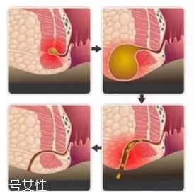 肛瘺非手術(shù)治療才可以嗎？手術(shù)是治療的關(guān)鍵途徑