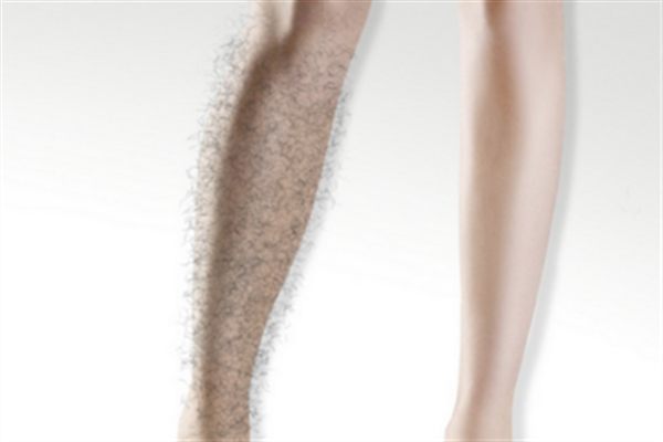 激光脫毛有哪些優(yōu)勢？激光脫毛的方式