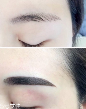 激光洗眉恢復(fù)期有疤痕怎么辦？激光洗眉毛之后正確護(hù)理方法