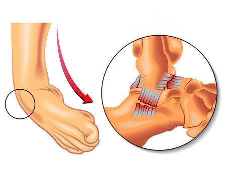 崴腳了怎么辦？緩解疼痛6大招