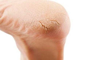 冬天裂腳怎么辦？5招緩解裂腳