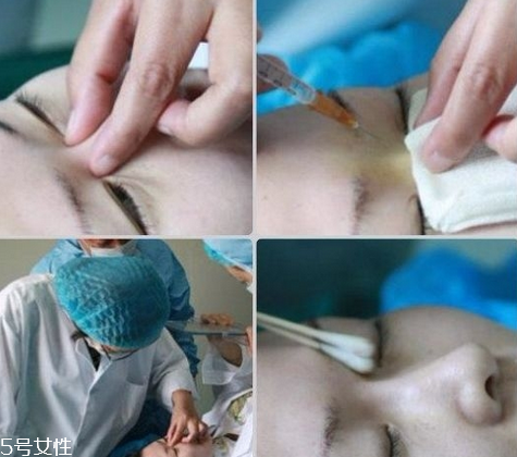 玻尿酸隆鼻維持時(shí)間受什么影響？玻尿酸不能過(guò)度注射