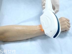 激光脫毛需要幾次？激光脫毛并不是終身有效的