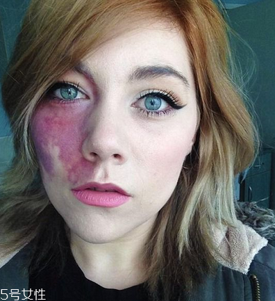 胎記長(zhǎng)在哪里有福氣？胎記的本質(zhì)是色素沉著