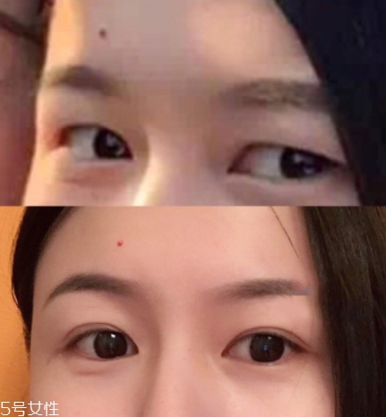 內雙怎么進化成雙眼皮？全是雙眼皮貼的功勞