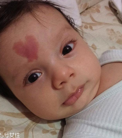 胎記長(zhǎng)在哪里有福氣？胎記的本質(zhì)是色素沉著