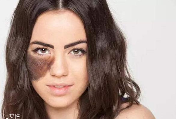 胎記長(zhǎng)在哪里有福氣？胎記的本質(zhì)是色素沉著