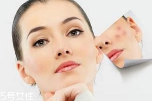 痘印多久能自行消失？多數(shù)人一年內(nèi)消失