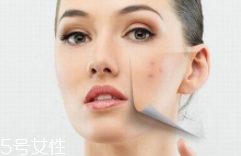 痘印多久能自行消失？多數(shù)人一年內(nèi)消失