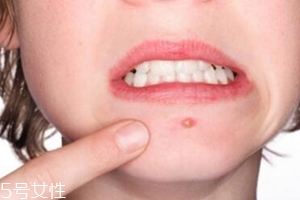 肌膚需要排毒嗎？長痘并不代表排毒