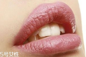 冬天爛嘴角什么原因？有可能營(yíng)養(yǎng)不良