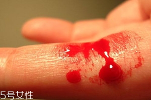 血友病的主要表現(xiàn)有哪些？出血是最明顯的特征