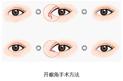 開眼角疤痕多久消失？開眼角的適宜人群