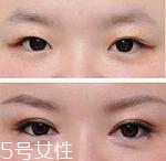 開眼角疤痕多久消失？開眼角的適宜人群