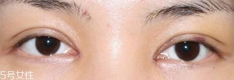 怎么縮短開眼角疤痕消失時間？雙眼皮開眼角恢復(fù)過程
