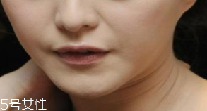 頸紋是怎么產(chǎn)生的？比面部肌膚更加脆弱