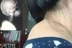 富貴包是什么病？姿態(tài)優(yōu)美少犯病