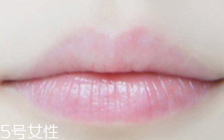 嘴唇干裂是一種病嗎？治療口角炎從改善習慣入手