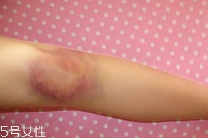 身體淤青怎么來的？不是磕碰那么簡單