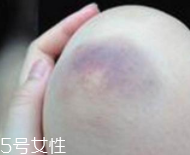 身體淤青怎么來的？不是磕碰那么簡單