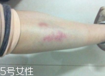 身體淤青怎么來的？不是磕碰那么簡單