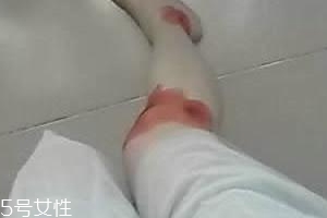 摔傷了涂什么藥好的快？做好消毒才能愈合快