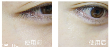 shangpree香蒲麗眼膜適合多大年齡？任何年齡