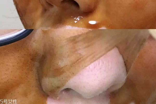 雪花秀撕拉面膜怎么撕出黑頭？這么做才能去黑頭