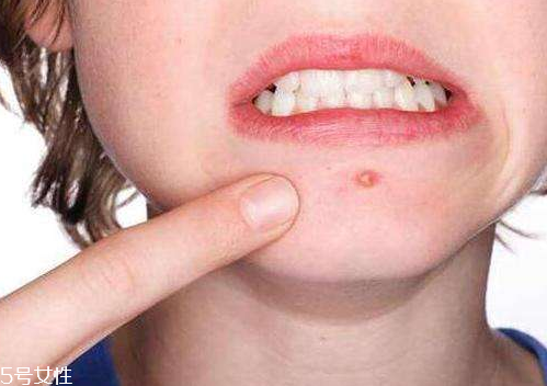 skinb5抗痘護(hù)膚片有效果嗎？