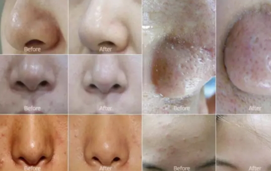 弄完小氣泡多久可以化妝？小氣泡注意事項