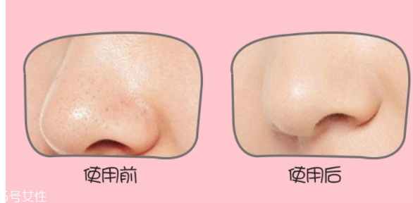 yoii黑頭儀怎么用？yoii黑頭儀怎么充電