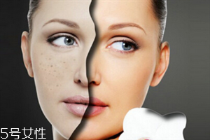 太陽穴長(zhǎng)痘痘是什么原因 怎么避免長(zhǎng)痘痘 