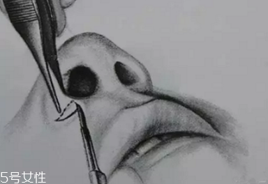 鼻翼外切多久消腫？鼻翼外切消腫時間要多長？