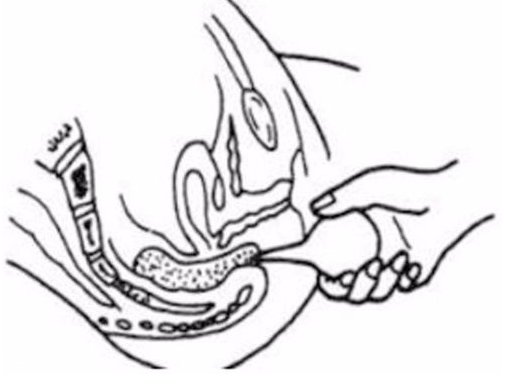 開塞露躺著還是蹲著用？開塞露使用姿勢