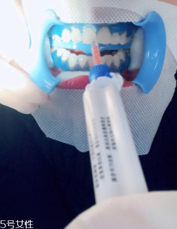 冷光美白會反彈嗎？冷光美白心得
