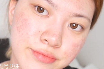 大面積痘印怎么遮瑕 大面積痘印底妝遮瑕教程 大面積痘印怎么遮瑕 大面積痘印底妝遮瑕教程